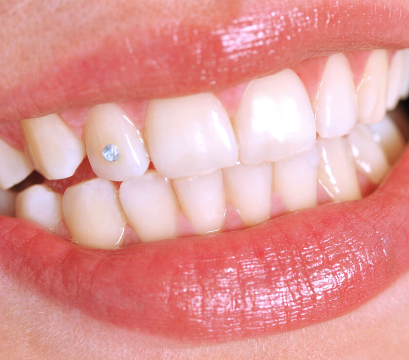 Grillz dental y joyas dentales