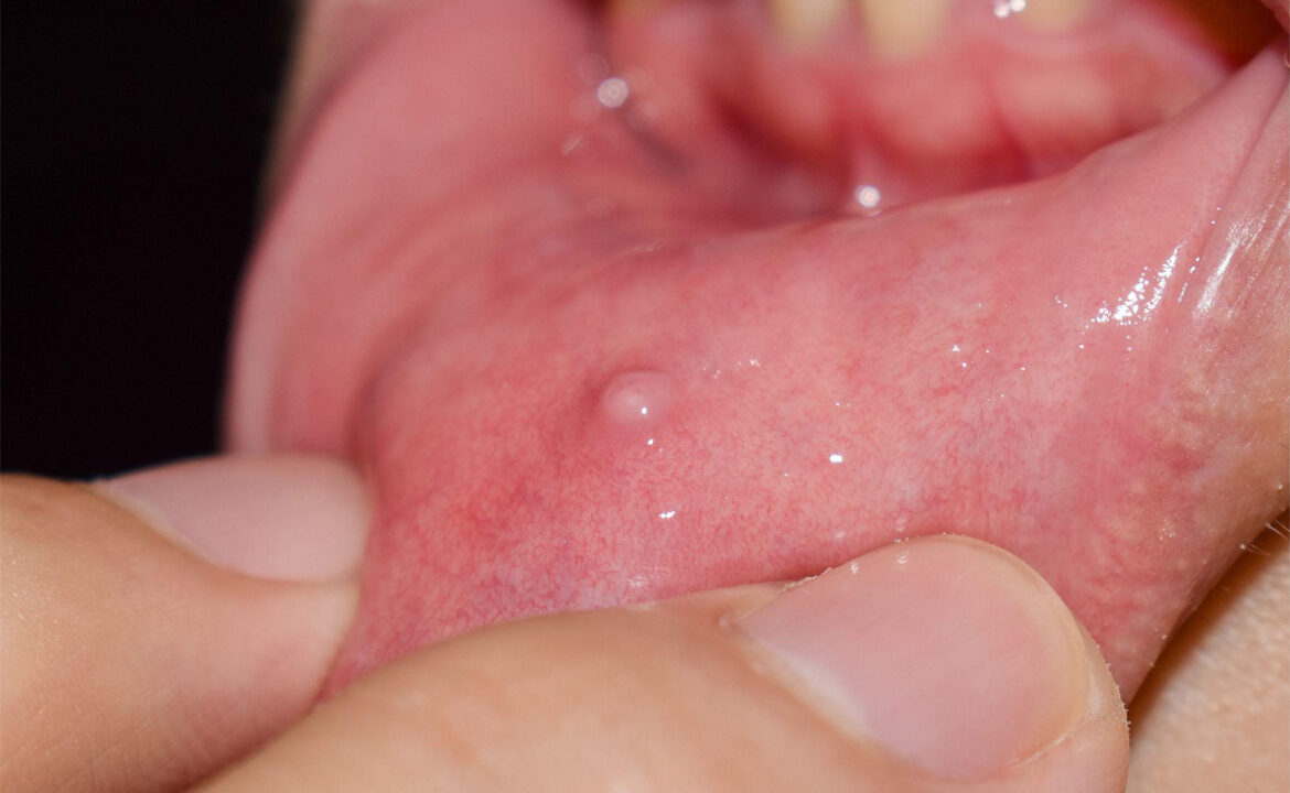 Mucocele