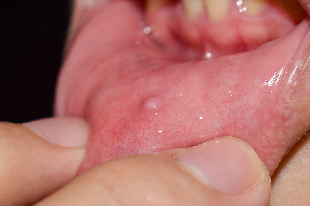 Mucocele