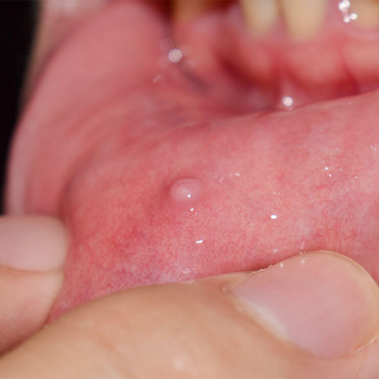 Mucocele