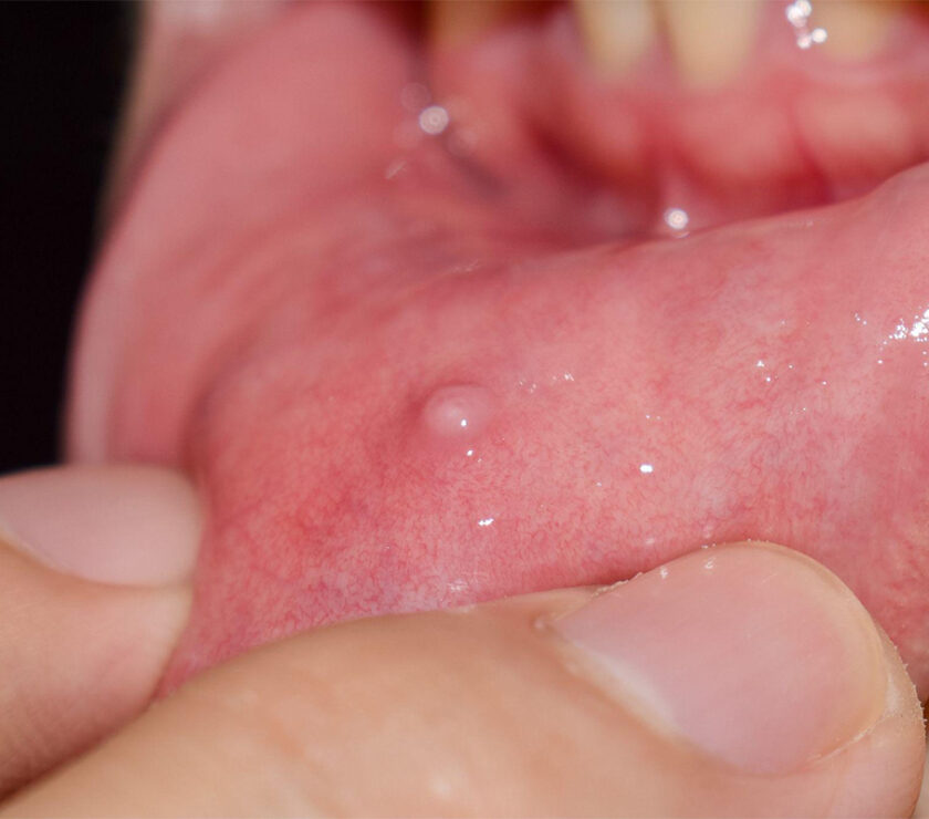 Mucocele