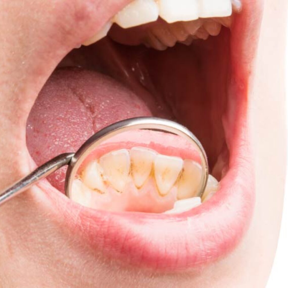sarro dientes