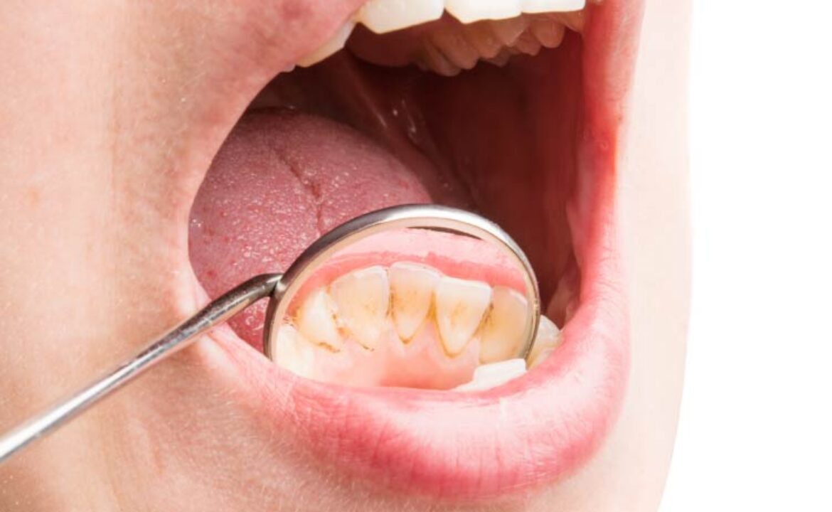 sarro dientes