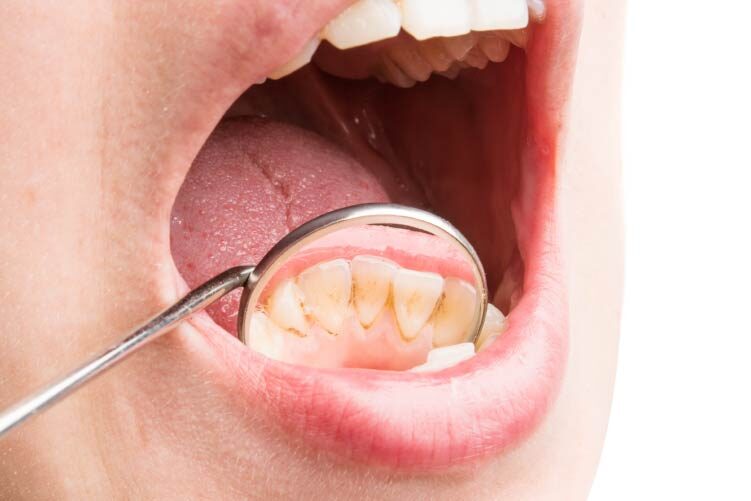 sarro dientes