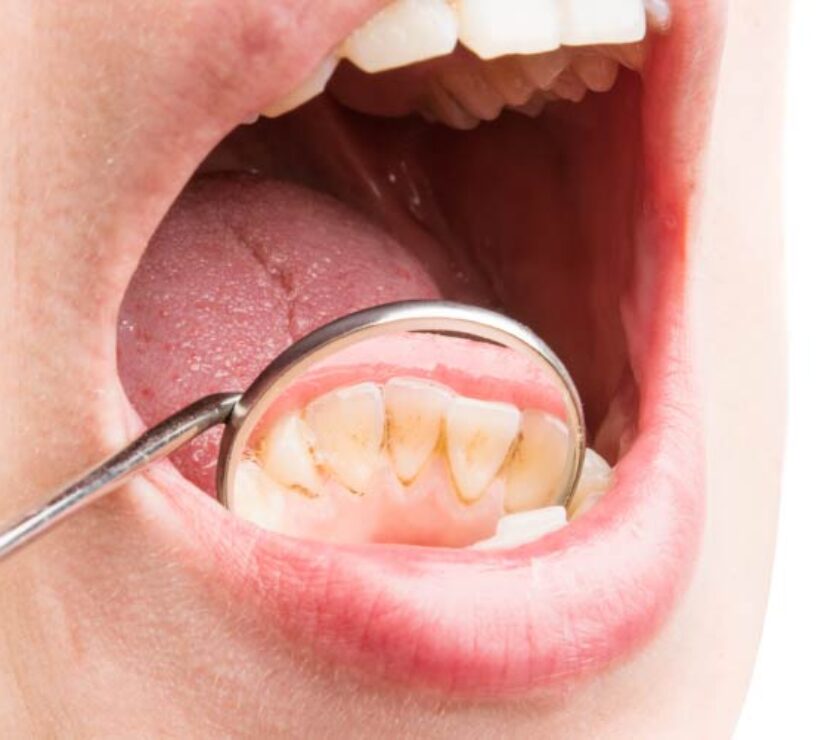 sarro dientes
