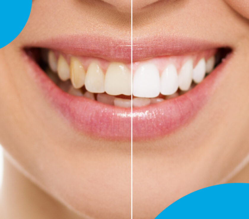 color dientes